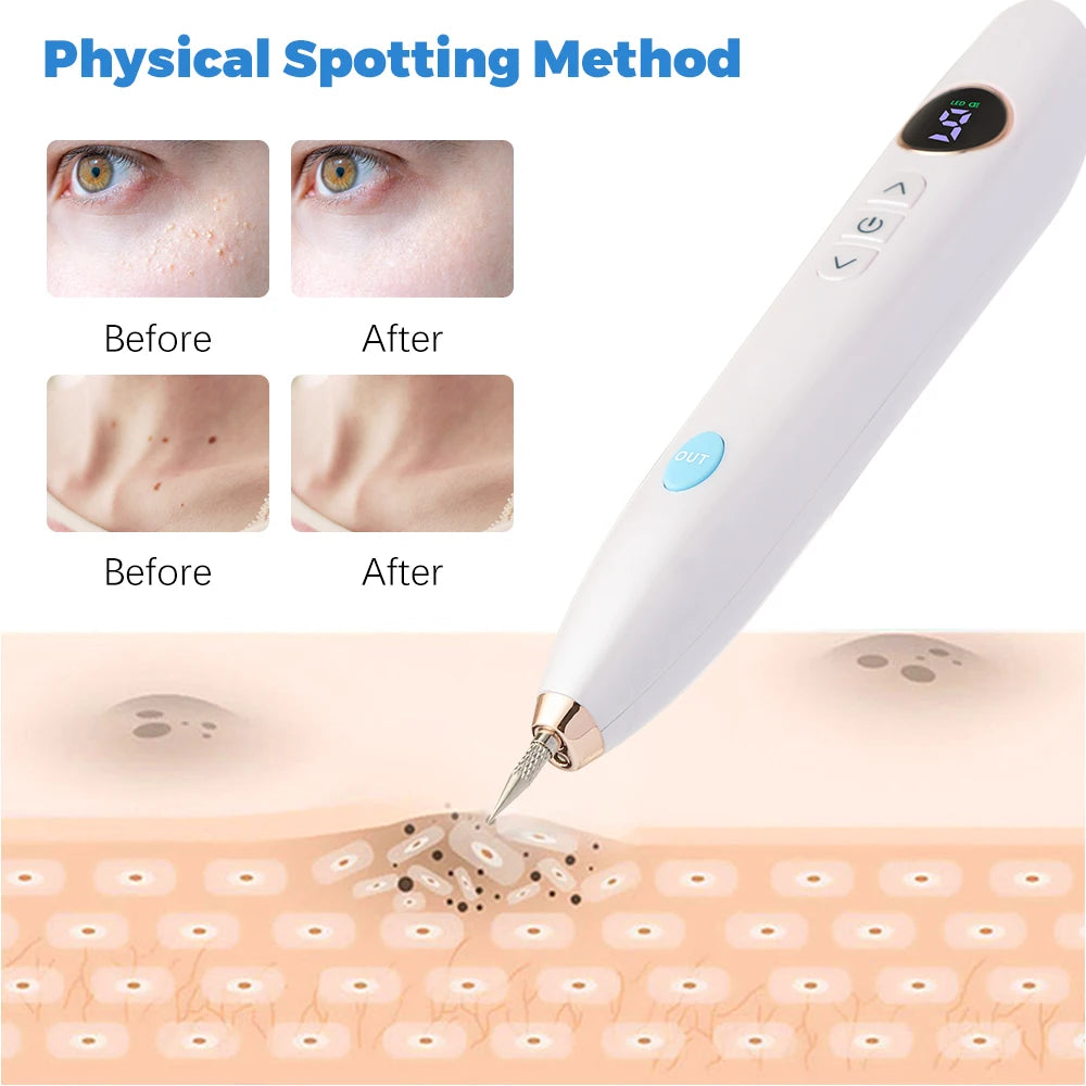 SkinFix™ – עט חשמלי להסרת כתמים ונקודות עור