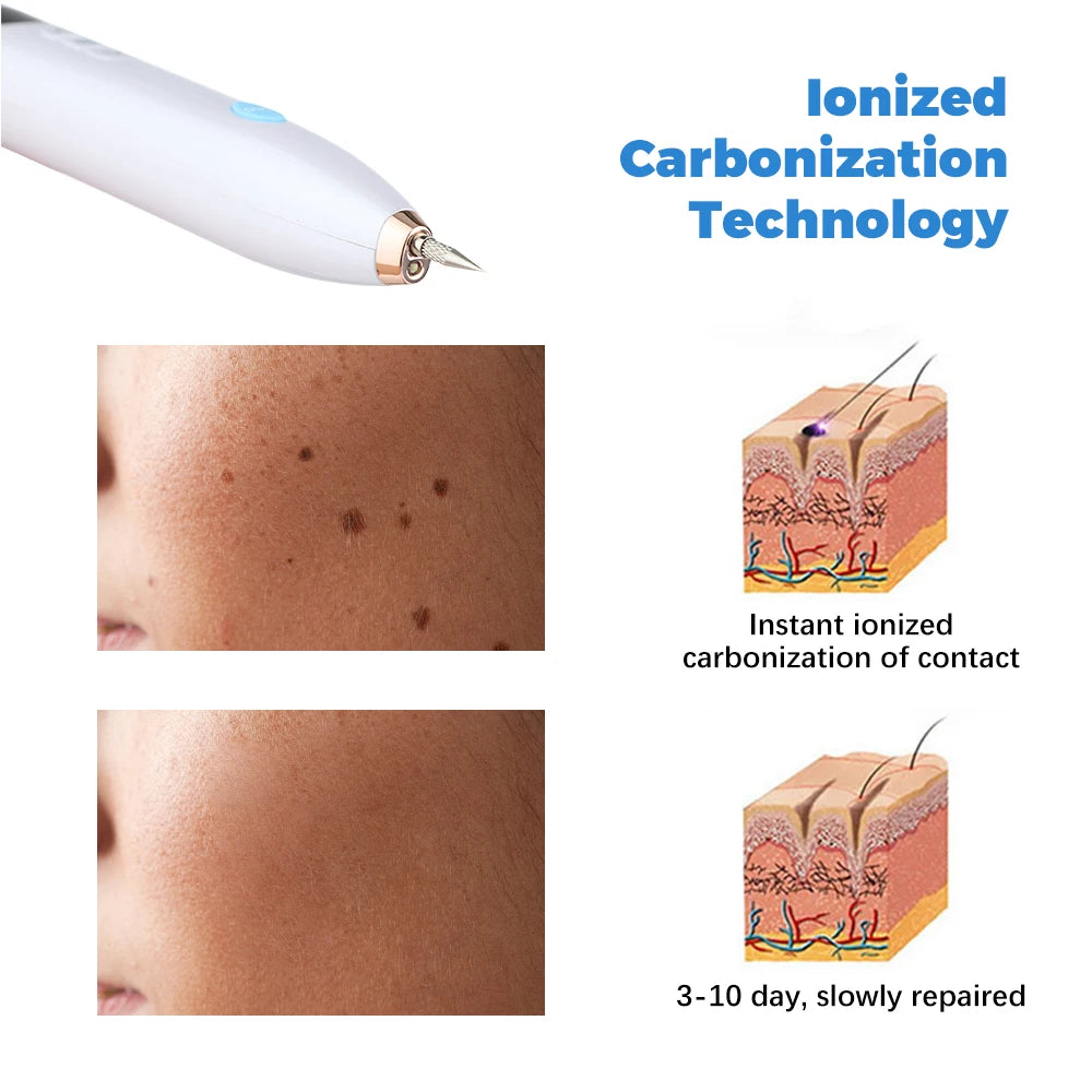SkinFix™ – עט חשמלי להסרת כתמים ונקודות עור